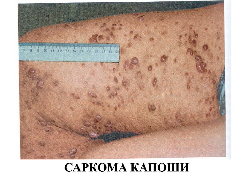 САРКОМА КАПОШИ